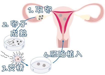 单身生育力保存